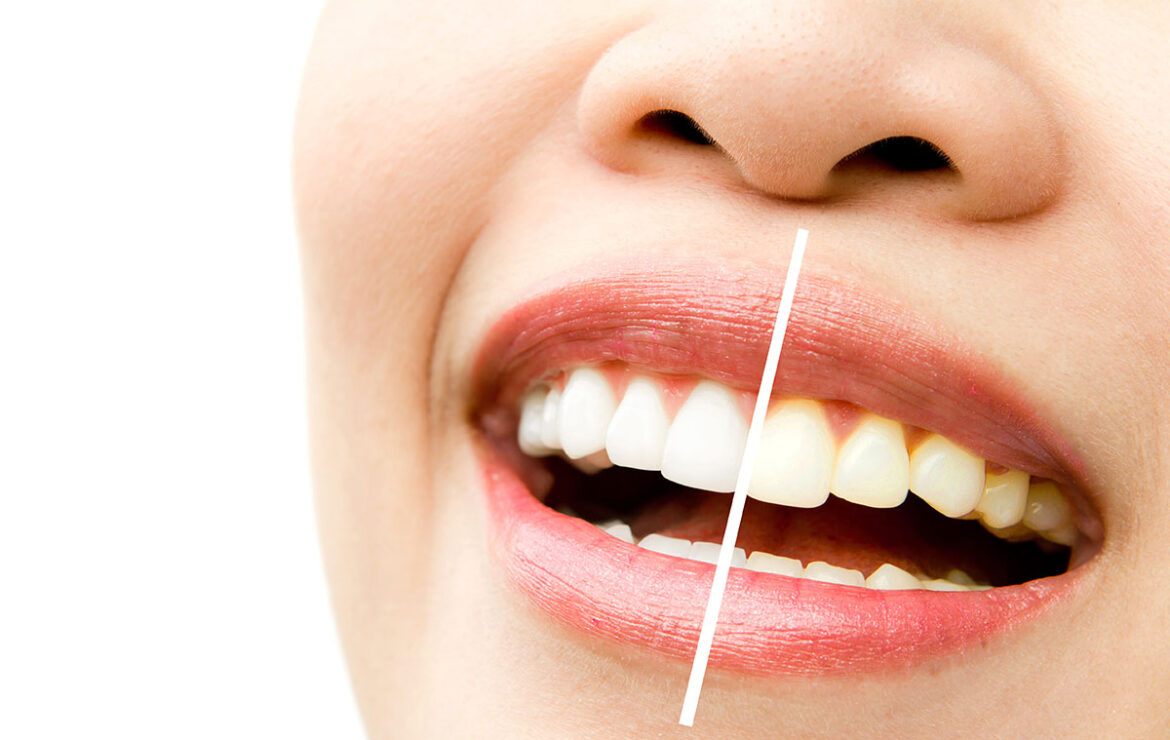 Yellow Teeth? Here’s How to Whiten Yellow Teeth | Pramukh Dental Care